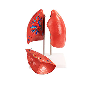 <a href=''><span style='color:#2f82c5; display:inline; font-weight:bold;'>Lung anatomy model</span></a> <a href=''><span style='color:#2f82c5; display:inline; font-weight:bold;'>Lung anatomy model</span></a>
